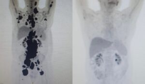 Remissão e cura do câncer: saiba a diferença e como funciona a terapia CAR-T no SUS