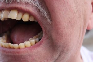 Canabinoides ganham espaço no tratamento da dor e ajudam a reduzir uso de opioides